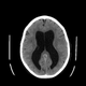 Tomografía mostrando acumulación del líquido cefalorraquídeo. Wikimedia Commons